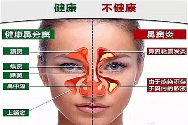 開一家鼻炎店賺錢嗎